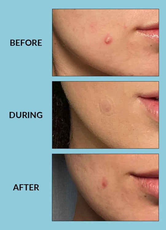 TALIKA Free Skin Patch 25 PATCHES | Acne and Blemish Treatment with Salicylic Acid, Niacinamide, and Azelaic Acid-5