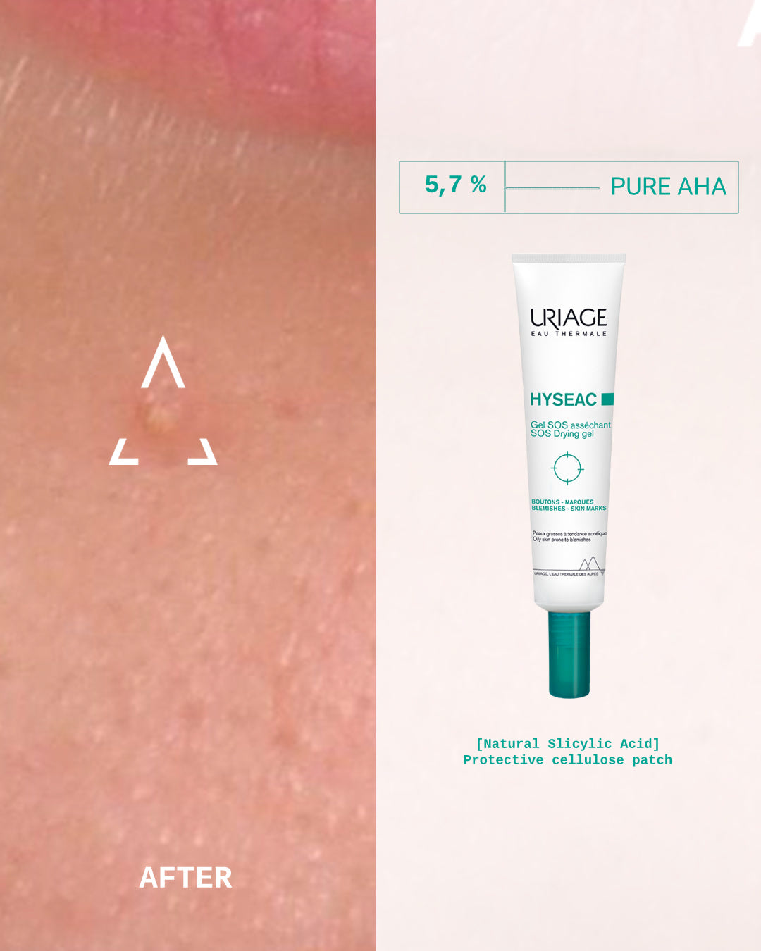 Uriage Hyseac SOS Paste - Targeted Spot Treatment for Acne-Prone Skin - 15ml-3