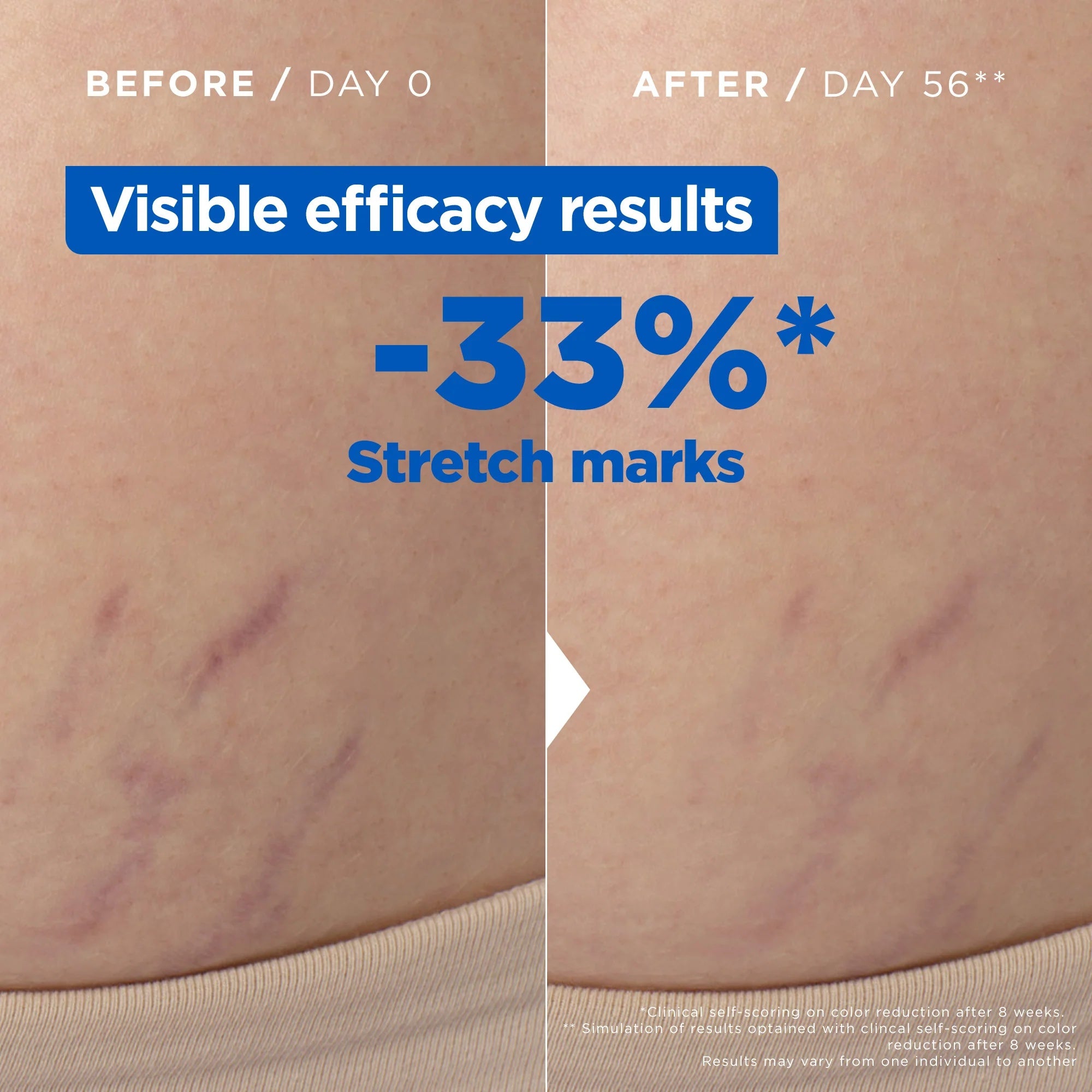 Mixa Stretch Mark Oil 30% Omega 6 & 9-5