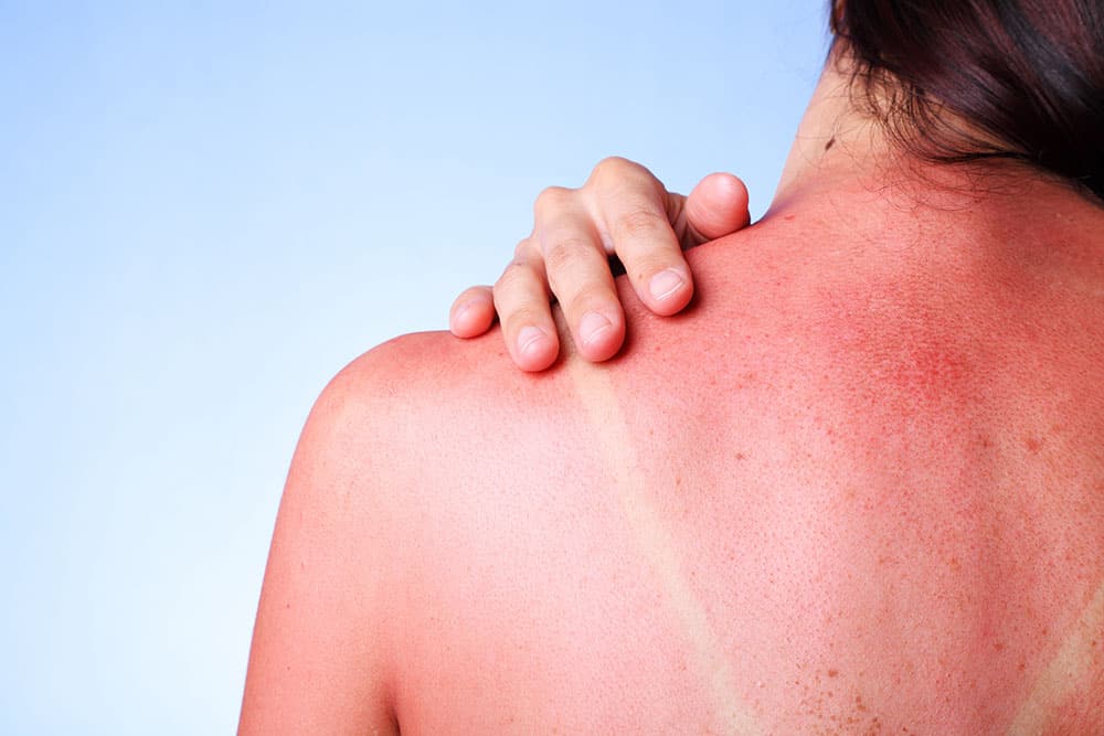 Sun Burns