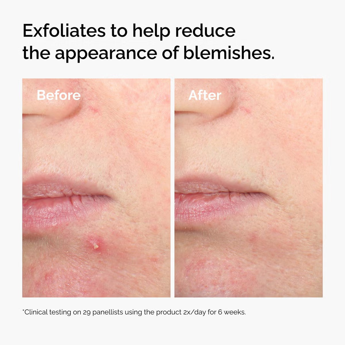The Ordinary Salicylic Acid 2% Solution 30ml