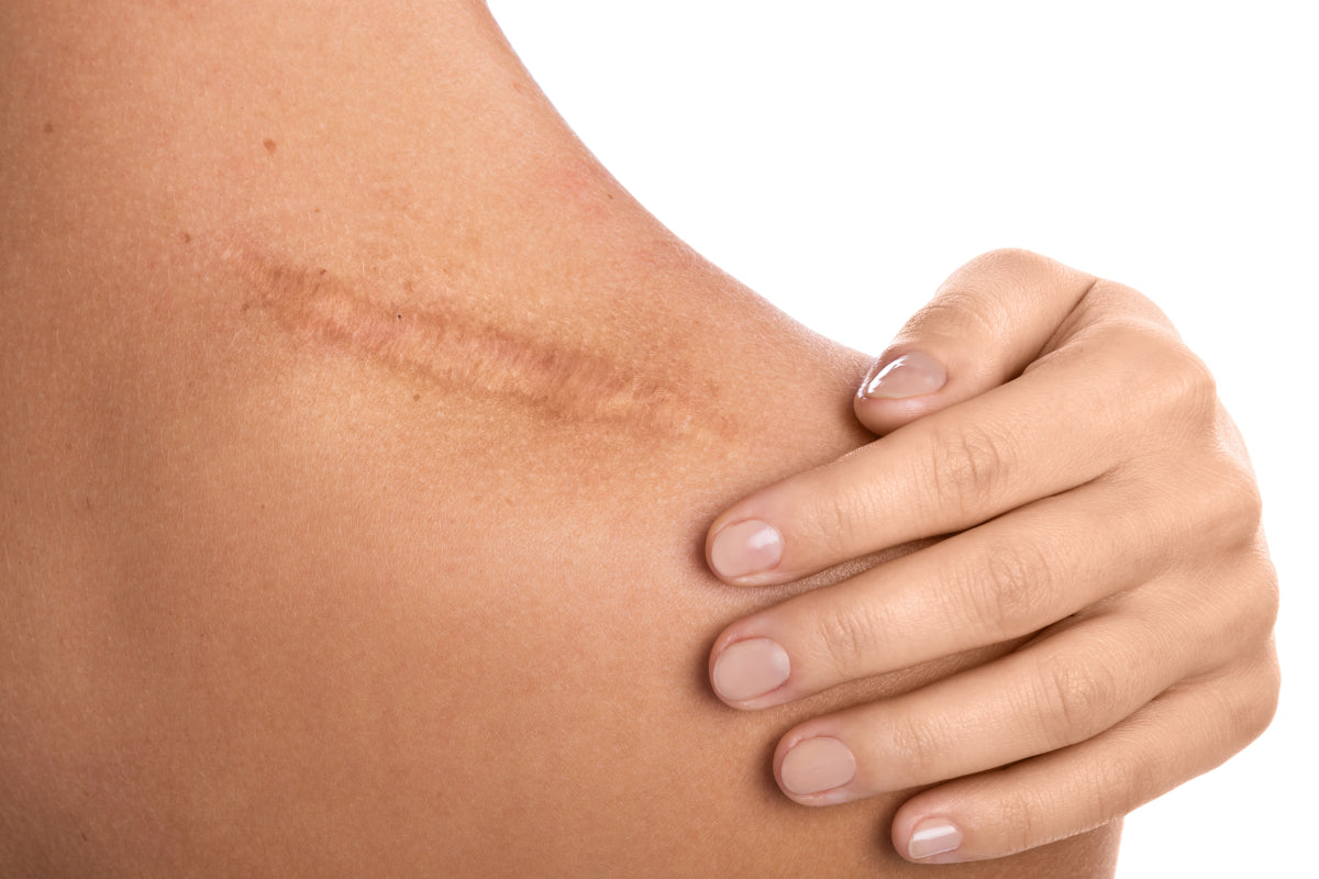 Scars