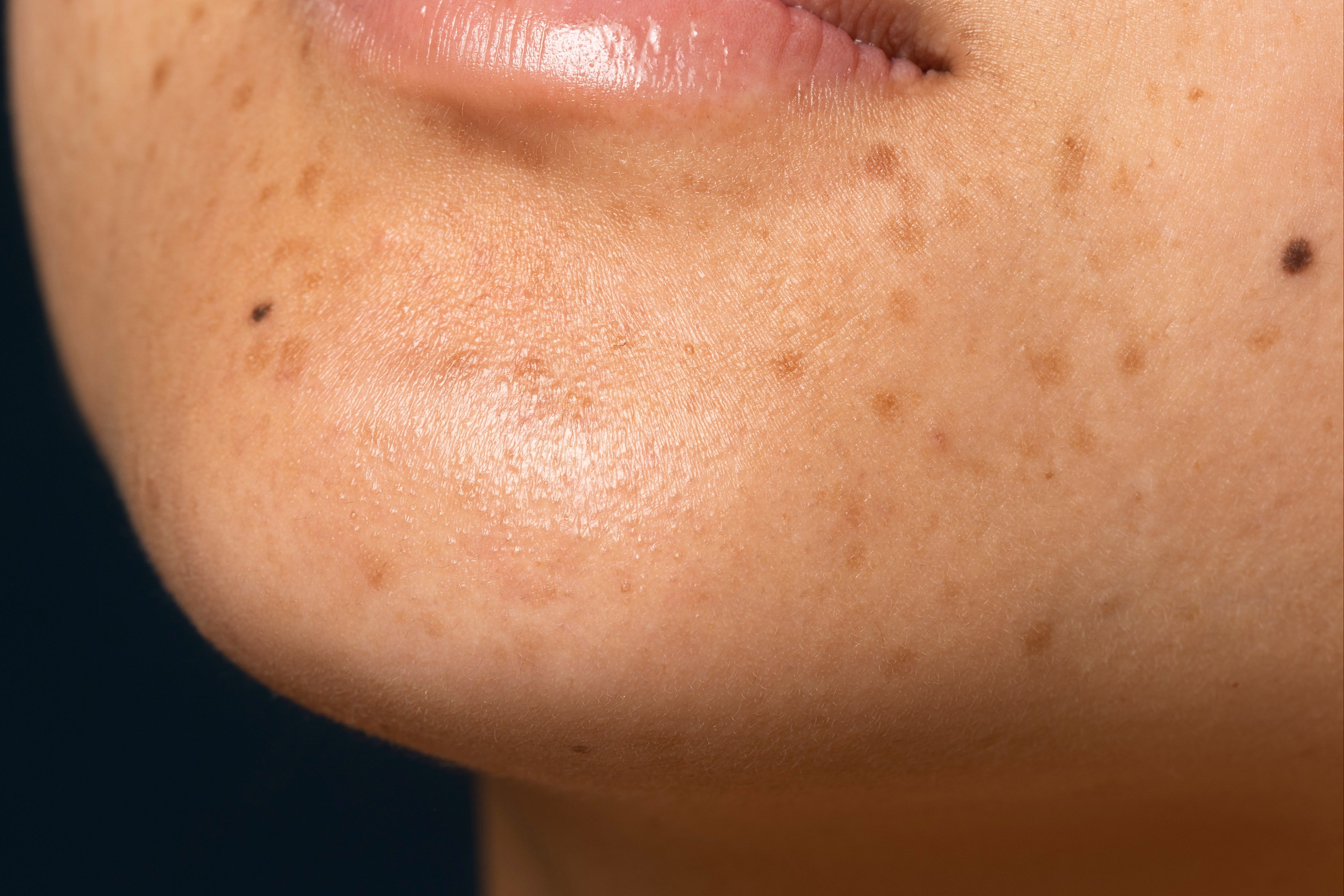 Dark Spots