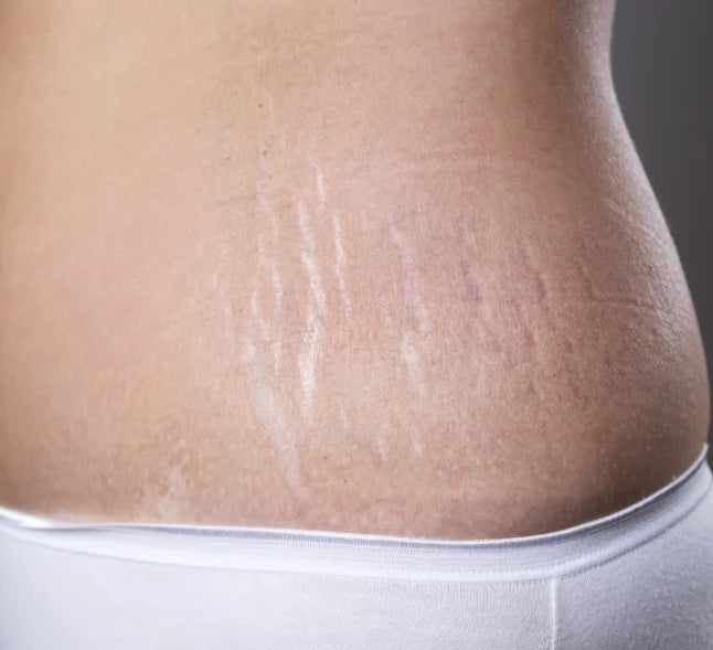 Stretch Marks